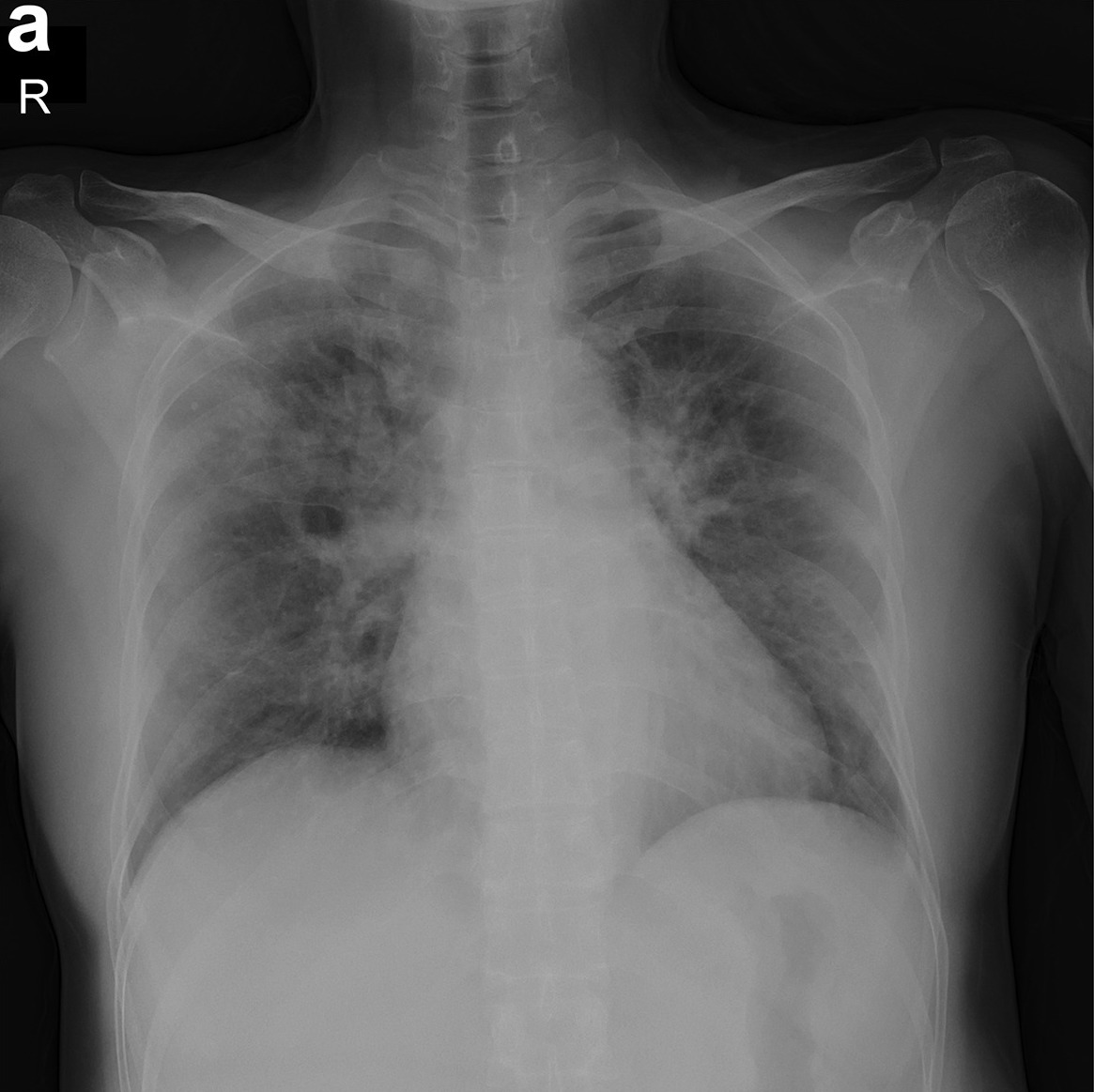 Chest X-ray AI